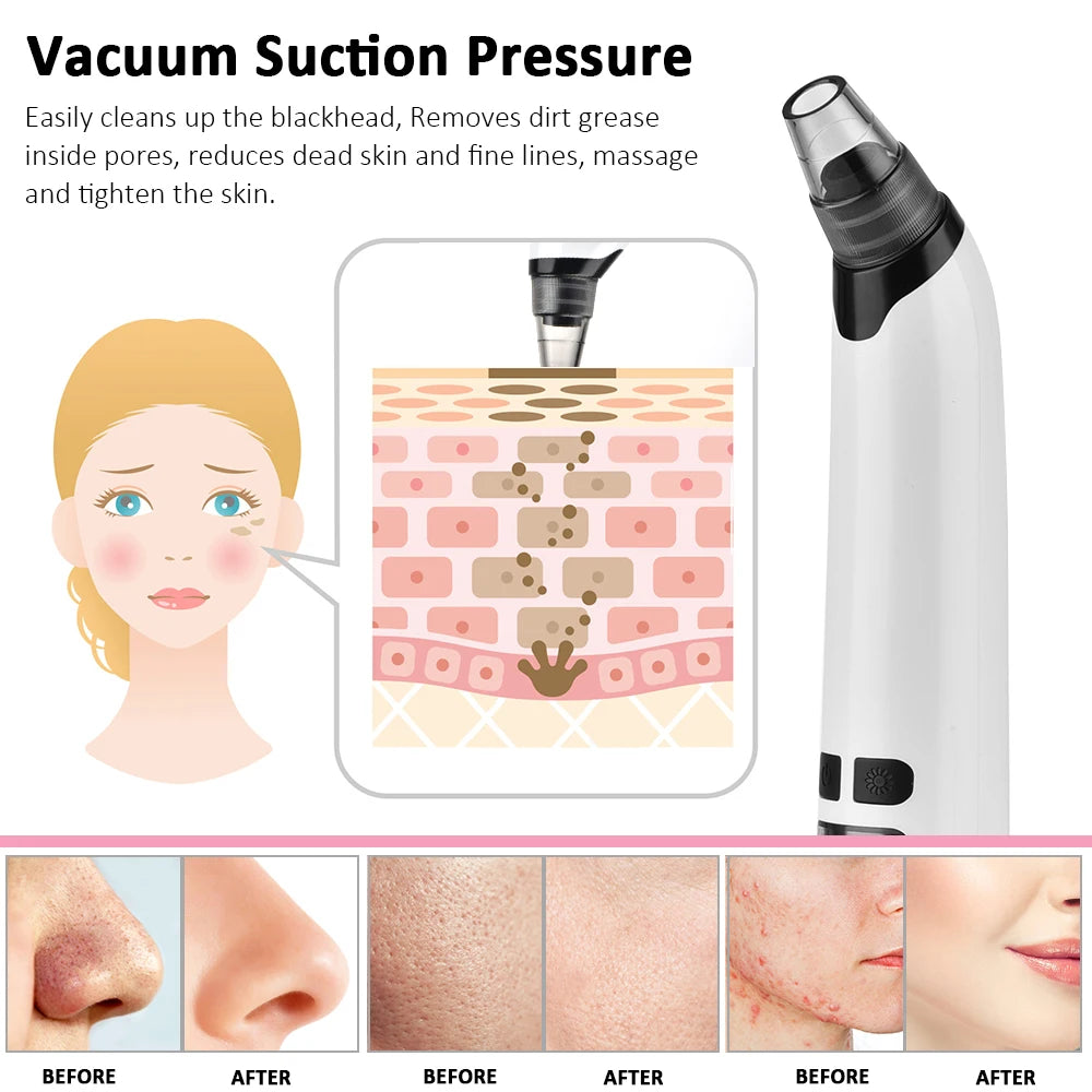 Electric Blackhead Remover Device and Mist Sprayer Face Skin Tester Skin Care Set Black Dots Vacuum Suction Face Cleaner Nourish