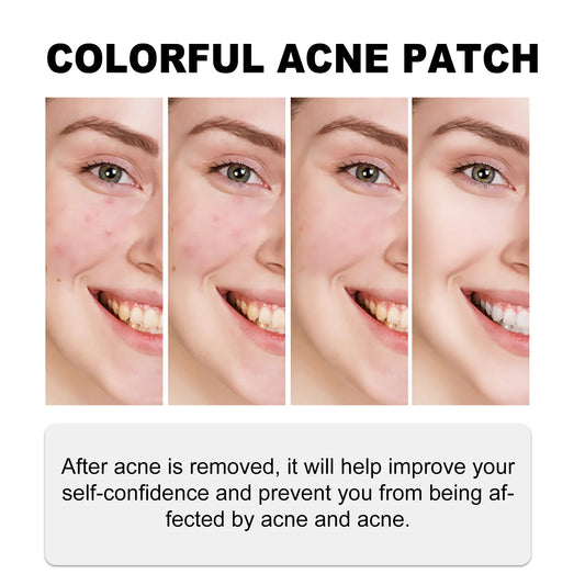 140Pcs Green Acne Patch Reduce Acne And Repair Facial Acne Scars Irregular Shaped Colored Stickers For Facial Skincare